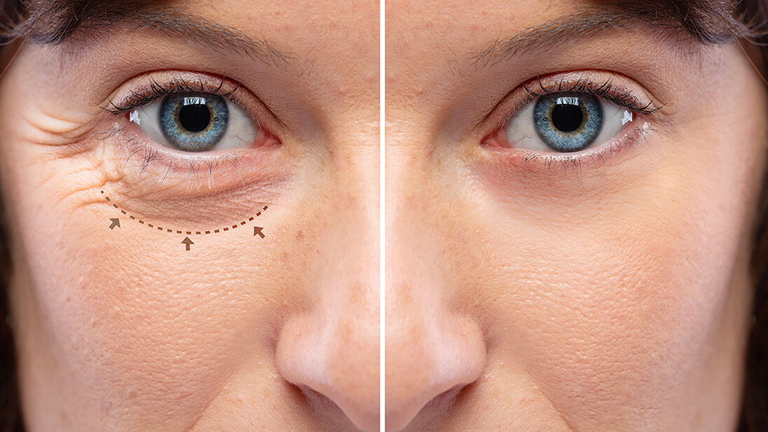 eyelid surgery turkey
