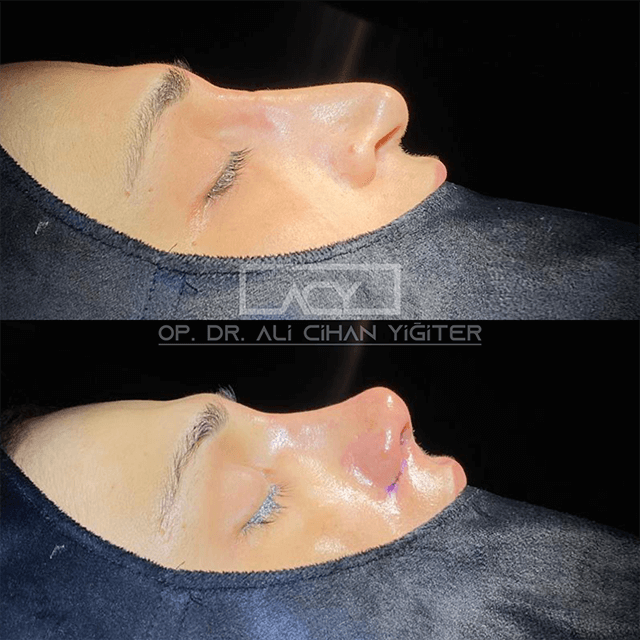 revision-rhinoplasty-before-after-image-13.png