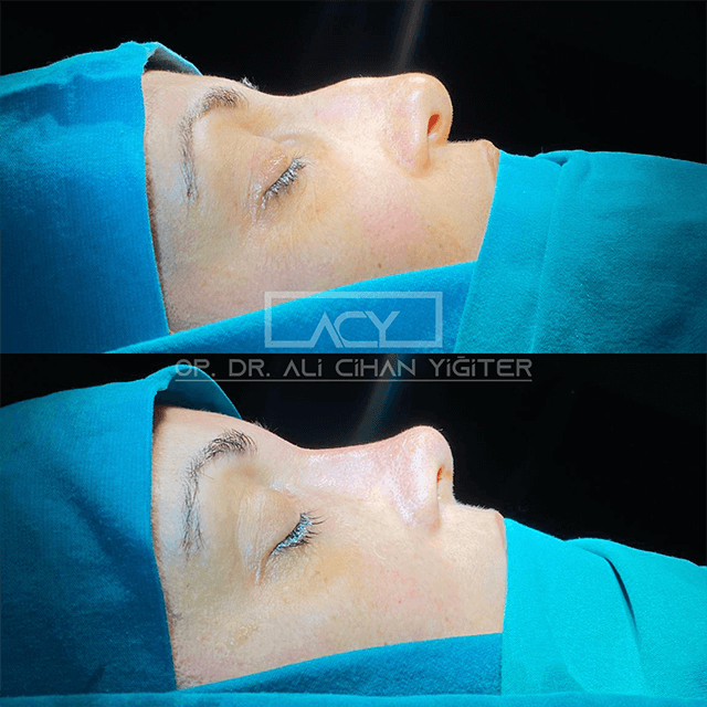 revision-rhinoplasty-before-after-image-8.png